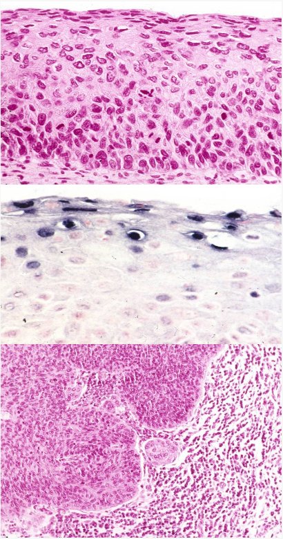 Karzinomatöse Umwandlung des Oberflächenepithels des Gebärmutterhalses — Assoziation mit Tumorzellen — Karzinomfokus