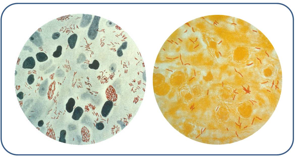 Mycobacterium leprae in einer Hautläsion (links), Mycobacterium tuberculosis in einer Sputumprobe (rechts)